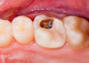 molar with cavity