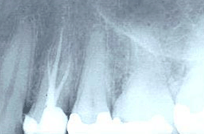 Root Canal Gallery Case 1 