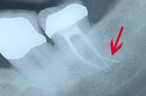 Root Canal Gallery Case 3 - Accessory Canals 