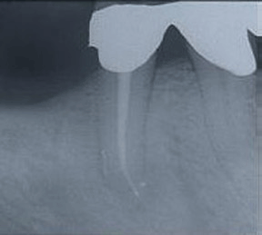 Root Canal Gallery Case 9 -Successful Root Canal 