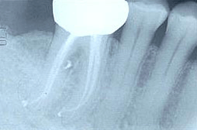 Root Canal Gallery Case 7 - Successful Root Canal 