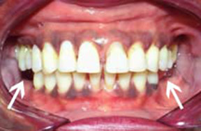 Dentures Gallery Case 2 