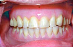 Dentures Gallery Case 3 