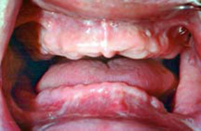 Dentures Gallery Case 3 