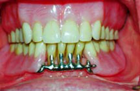 Dentures Gallery Case 4 