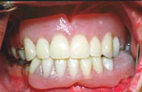 Dentures Gallery Case 5 