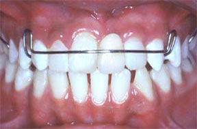 Dentures Gallery Case 6 