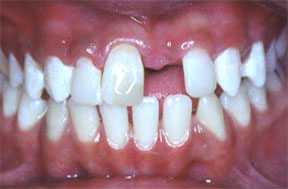 Dentures Gallery Case 6 