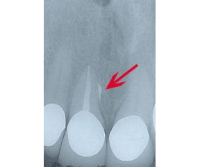 Root Canal Gallery Case 2 - Accessory Canals 