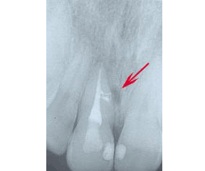 Root Canal Gallery Case 2 - Accessory Canals 