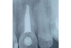 Root Canal Gallery Case 5A and 5B- Large Canals 
