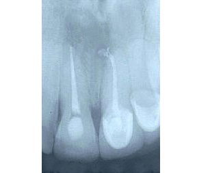 Root Canal Gallery Case 6 - External Resorption 