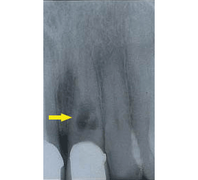 Root Canal Gallery Case 8 - Internal Resorption 