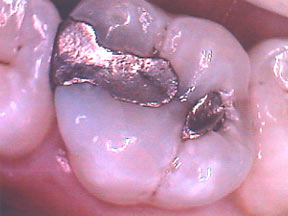 Fillings Case 2 Porcelain Inlay 