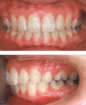 Orthodontic Gallery Case 1 