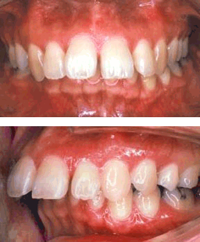 Orthodontic Gallery Case 1 