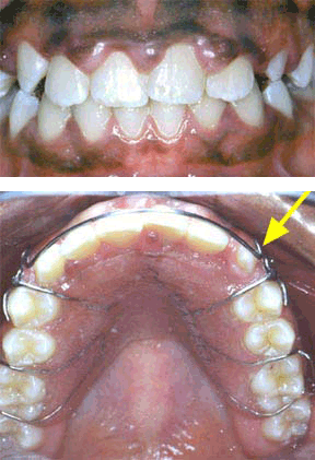Orthodontic Gallery Case 8 