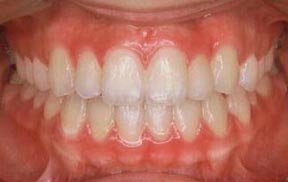 Orthodontic Gallery Case 3 