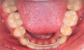 Orthodontic Gallery Case 10 