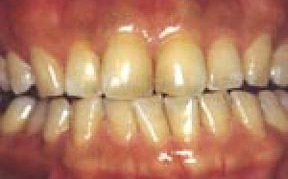 Teeth Whitening Gallery Case 2 
