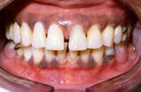 Dentures Gallery Case 2 