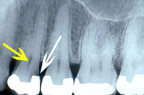Root Canal Gallery Case 1 