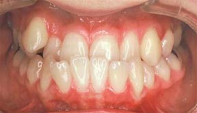 Orthodontic Gallery Case 2 