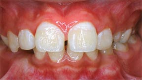 Orthodontic Gallery Case 4 