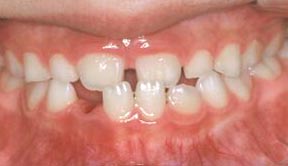 Orthodontic Gallery Case 5 
