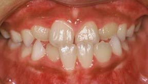 Orthodontic Gallery Case 6 