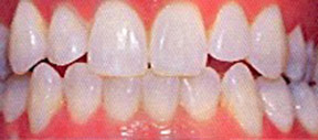 Teeth Whitening Gallery Case 1 