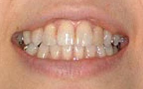 Teeth Whitening Gallery Case 3 